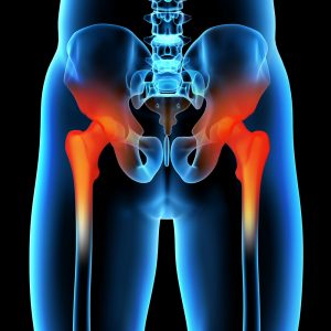 Osteoarthritis - Sport-Santé - Therapeutische körperliche Aktivitäten in Luxemburg